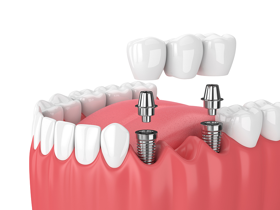 Complete Guide to Implant Restorations: Restoring Your Smile with Confidence